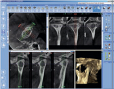 Dental CT Scan